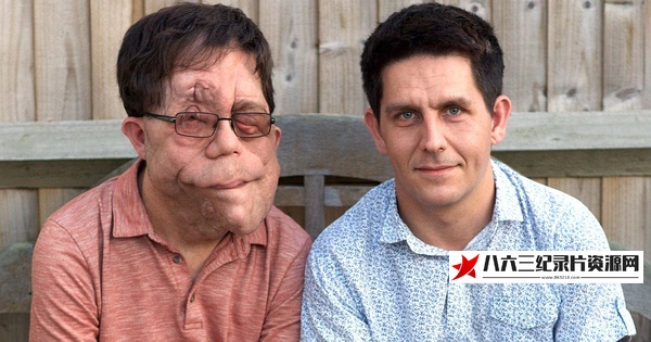 英国纪录片《我的神奇双胞胎 My Amazing Twin》高清下载-八六三纪录片资源网