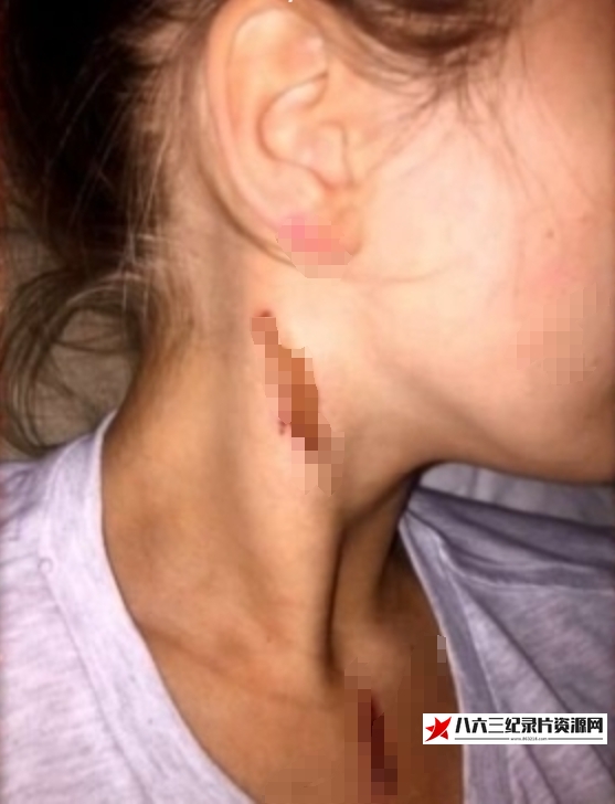 英国纪录片《英国泼酸袭击 Acid Attacks How Scared Should We Be》高清下载-八六三纪录片资源网