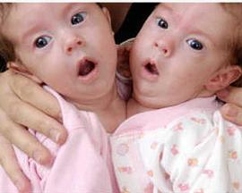 美国纪录片《异于常人：连体人 Inside Extraordinary Humans: Science of Conjoined Twins》高清下载-八六三纪录片资源网